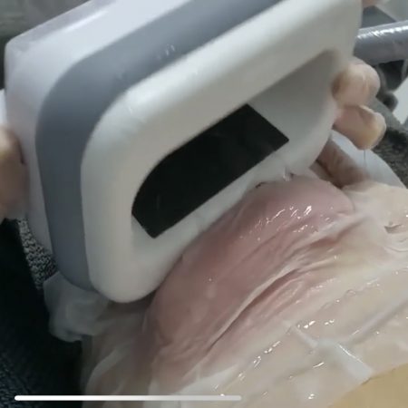 Kriolipoliza CoolTech - 1 głowica