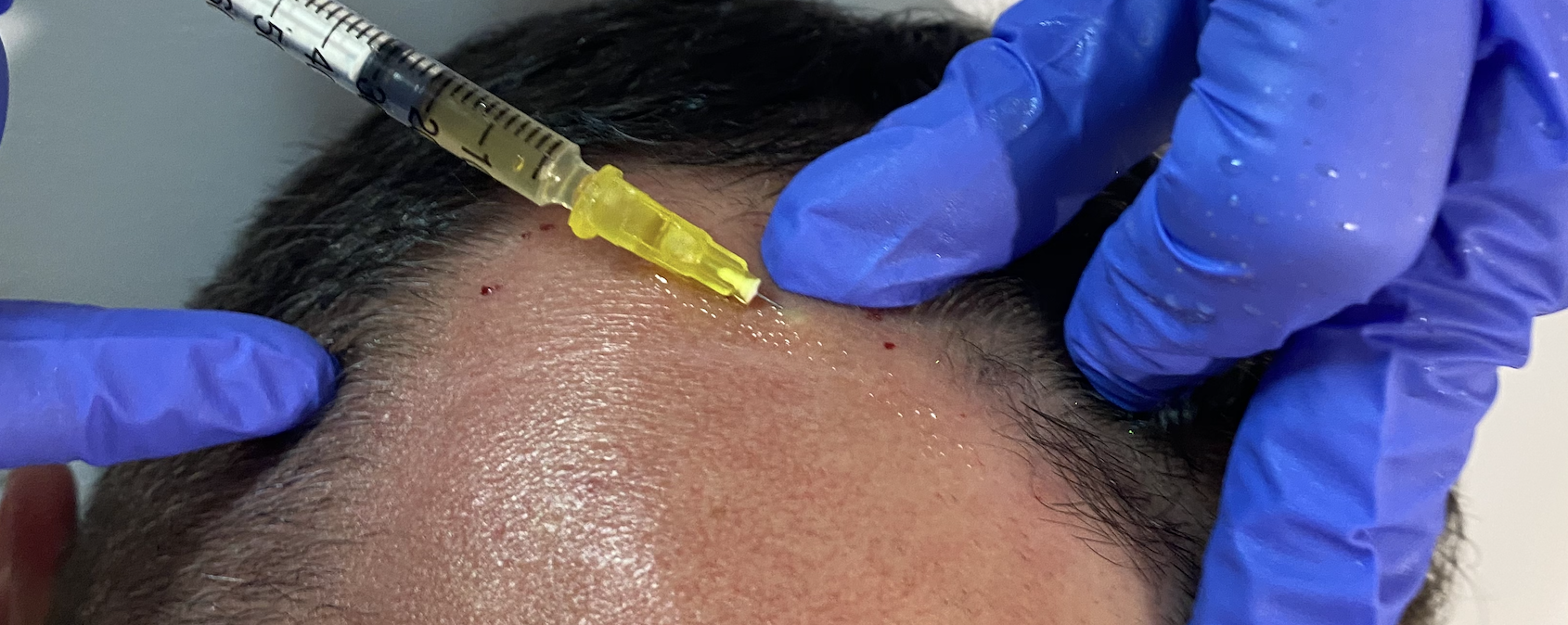 Leczenie łysienia - Mezoterapia - Dermaheal HL